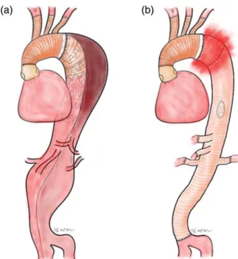 Figure 2: (a) Illustration showing well-seated stent grafts with no proximal endoleak after total arch replacement with the ET procedure and subsequent thoracic endovascular stent-grafting