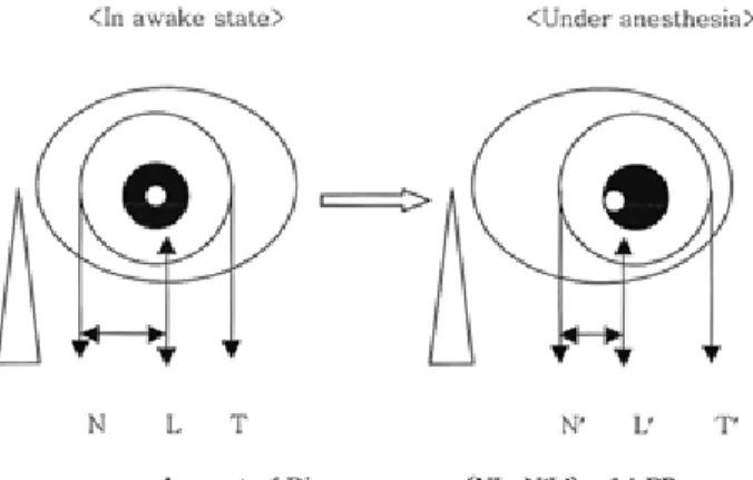 Fig. 1. Schematic illustration of eye position in both the  awakened state and the surgical  plane of anesthesia.