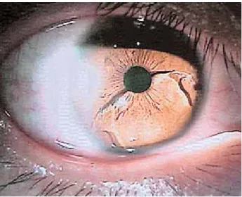 Figure 1. Dislocation of the Artisan lens into the nasal  angle. Right iris claw is dislocated from iris and left claw  remains enclaved