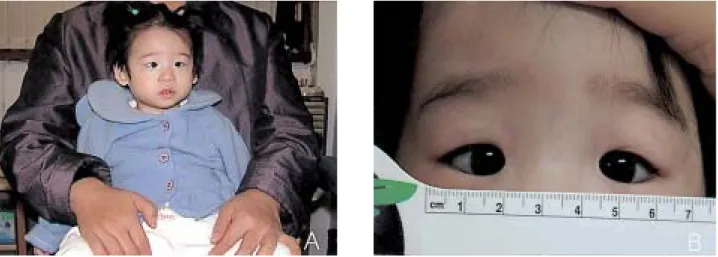 Figure 2. Tortuous retinal vessels. 