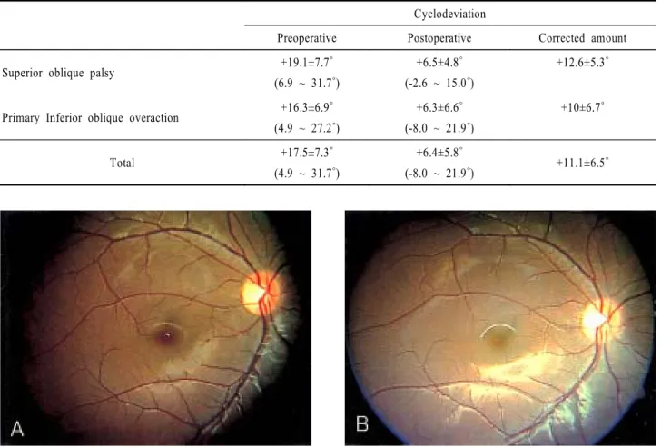 Table 2. Comparison of cyclodeviation angle after weakening  procedure of inferior oblique muscle
