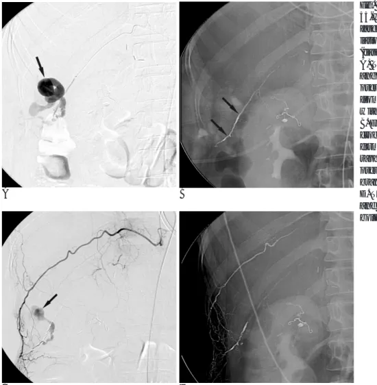 Fig. 3. Wound bleeding occurred in a 55-year-old woman with necrotizing fasciitis caused by radiofrequency  ab-lation of a hepatocellular carcinoma (case 2)