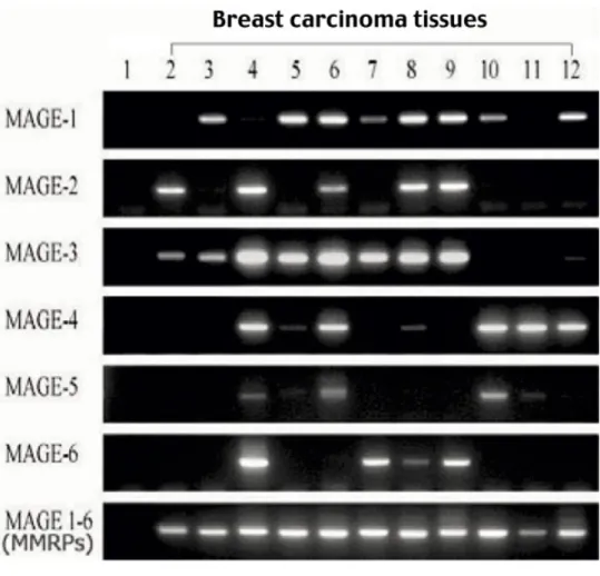 FIGURE 3. Melanoma antigen gene A (MAGE-A) expression in peripheral blood samples. MAGE-A gene expression was not detected in 32 patients with benign breast disease but was detected in 1 of 31 patients (3%) who had lymph  node-negative breast carcinoma, in