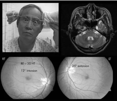 Figure 1 Tonic ocular tilt reaction in patient 1. Note sustained head tilt and concurrent vertical divergence of the eyes (skew deviation)