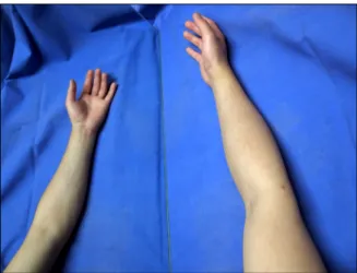Fig. 1. Mirror image. The patient is watching the reflected image of his intact right arm
