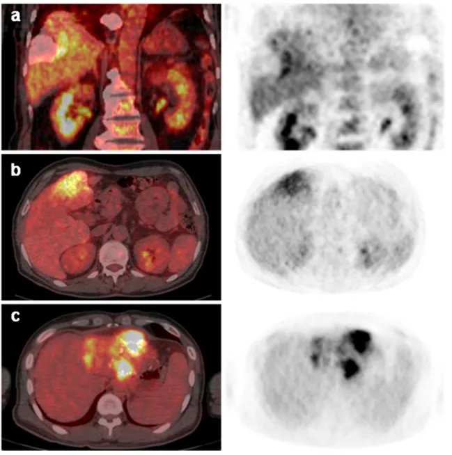 Fig. 1 a –c Representative cases of residual tumor. a A 69-year-old man received transcatheter arterial chemoembolization (TACE)