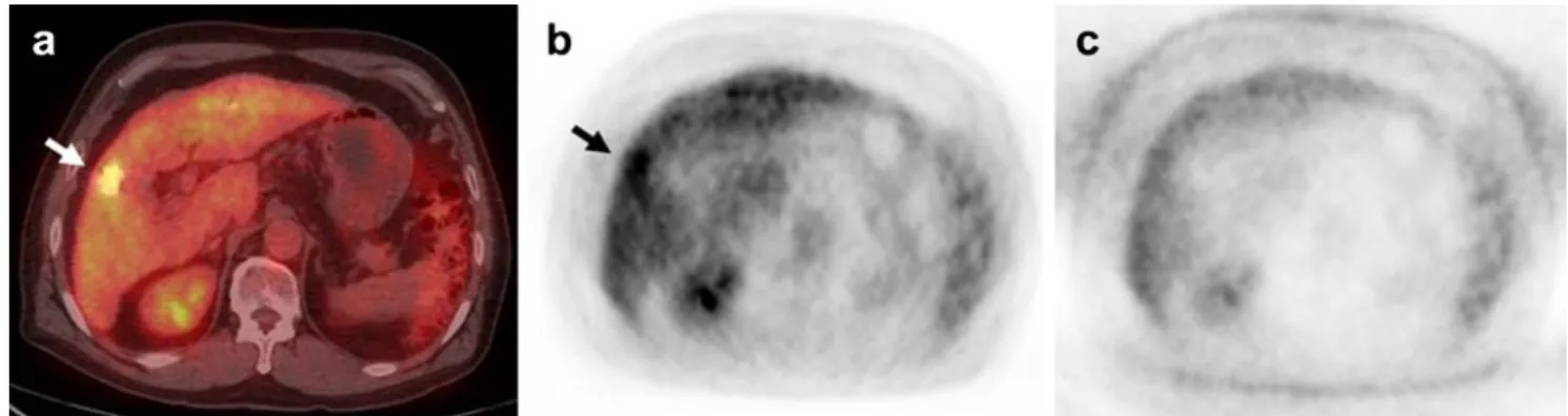 Table 2 shows the diagnostic values of post-treatment FDG PET/CT using visual analysis
