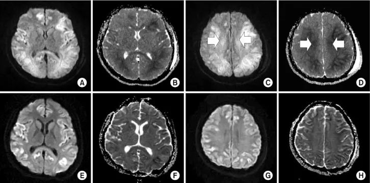 Fig. 1. MRI  of  patient  2.  The  initial  DWI  (A,  C)  and  ADC  maps  (B,  D).  Abnormal  signal  intensities  are  shown  in  the  symmetric  corona  radiata  (withe  arrow),  corpus  callosum,  caudate  neucleus,  and  diffuse  cerebral  cortex