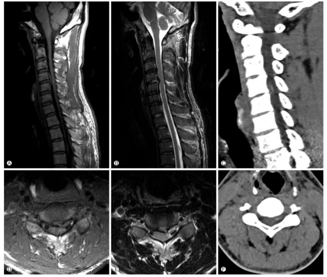 Fig. 2. T1-weighted sagittal (A) and axial (D), and T2-weighted sagittal (B) and axial (E) magnetic resonance image showing a large left paramedian C4-C5 disc herniation and severe compression of the spinal cord