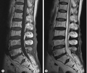 Fig. 1. T1-weighted image shows an iso-to-hyperintense signal lesion at L2-S2 level (A)