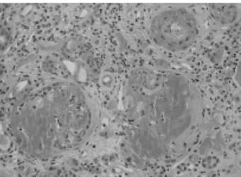 Figure 2. Glomerulus showing a large segmental deposits of amyloid and some trapped nuclei are visible in the large deposits but many cells have been lost (H &amp; E stain,