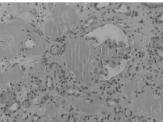 Figure 4. Electron micrograph shows deposition of fibrils (10nm diameter) accumulate in the mesangium and capillary walls of glomeruli (Original magnification,