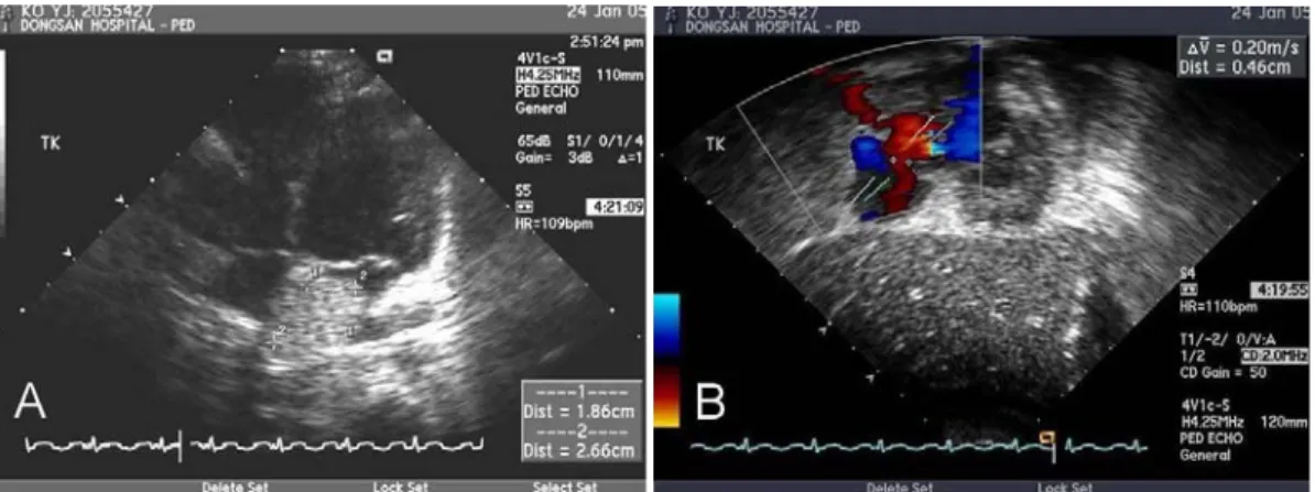 Fig. 3. Echocardiogram on admission showed left atrial mass of 2.6×1.8 cm (A) and atrial septal defect of 4.6 mm (B).