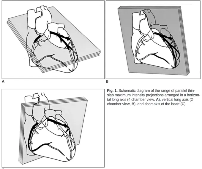 Fig. 1. Schematic diagram of the range of parallel thin- thin-slab maximum intensity projections arranged in a  horizon-tal long axis (4 chamber view, A), vertical long axis (2 chamber view, B), and short axis of the heart (C).