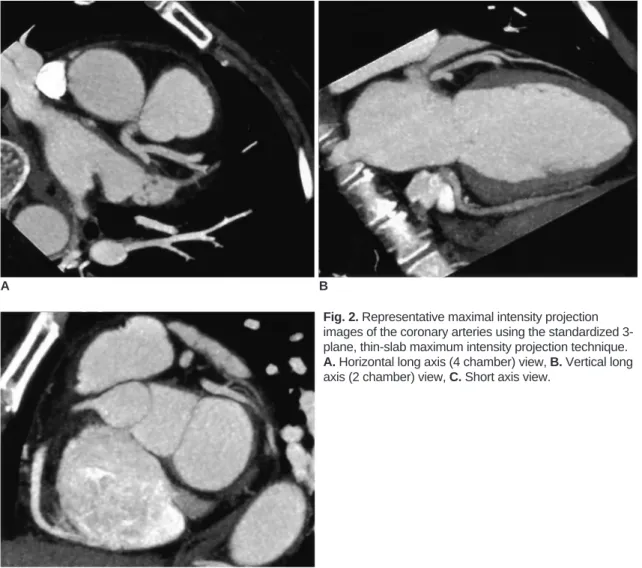 Fig. 2. Representative maximal intensity projection images of the coronary arteries using the standardized  3-plane, thin-slab maximum intensity projection technique.