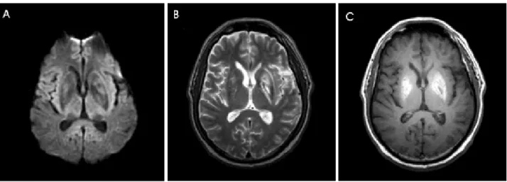 Figure 1. Brain MRI at admission. Axial diffusion-weighted image (A) and T2-weighted image (B) show bilateral, symmetrical high signal intensities at the both lentiform nuclei