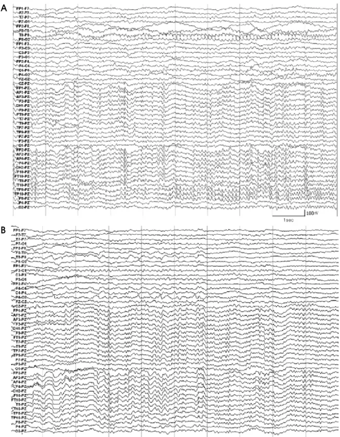 Figure 1. (A) The patient’s electroencephalography (EEG) shows that rhythmic epileptiform discharges are evolved from Rt