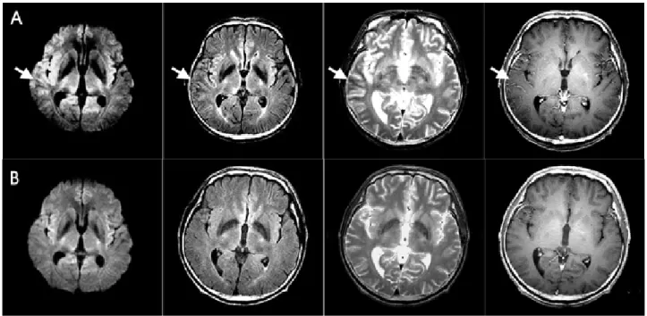 Figure 2. (A) At admission, MRI shows cortical hyperintensity and subcortical hypointensity (white arrows) in Rt