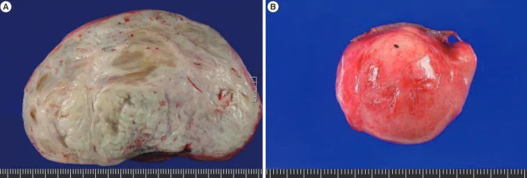 Figure 4. Microscopic findings of the retroperitoneal mass (A) and pulmonary nodule (B)