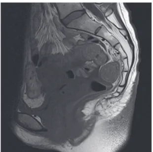 Figure 4. MR image taken 2 years after operation shows no  local recurrence.