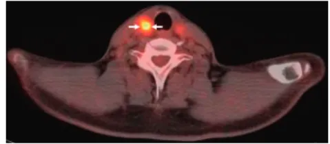 Fig 1. 18 F-FDG PET/CT image demonstrates an intensely hypermetabolic mass (SUV max ⫽ 9.1 g/mL) in the right thyroid lobe (arrows)
