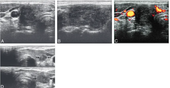 Fig 2. A, Transverse gray-scale US reveals a markedly hypoechoic mass with a taller-than-wide shape in the right thyroid lobe (delineated by electronic calipers)