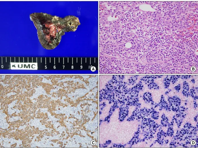 Figure  2.  (A)  Gross  appearance  reveals  2.5  cm  sized  round  to  oval  nodule  with  ill  demarcations  in  the  left  lower  lobe.