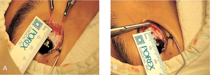 Table 2. Change of insertion toward limbus after disinsertion of medial and lateral rectus muscles