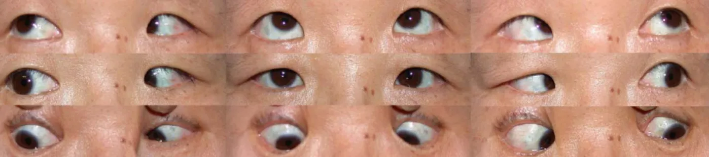 Figure 2. After tenectomy of the superior oblique muscle, photographs demonstrates the improvement of elevation in adduction  in the left eye.