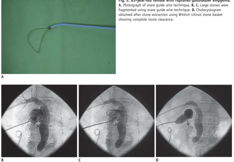 Fig. 2. 83-year-old female with ruptured gallbladder empyema.