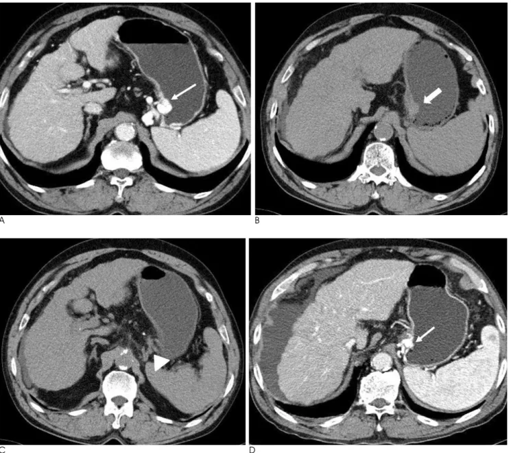 Fig. 2. A 71-year-old male presented with hematemesis. 