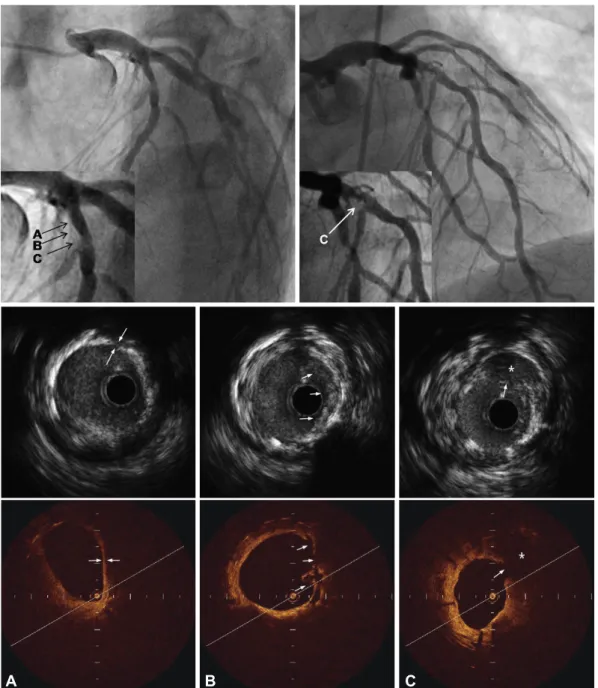 Fig. 1. Coronary angiogram (upper panel), intravascular ultrasound (middle panel) and optical coherence tomography (lower panel) images  of the in-stent restenosis site in the proximal left anterior descending artery