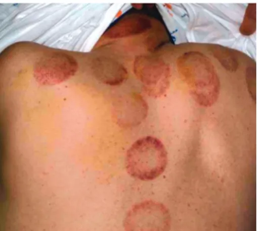 Figure  1. Characteristic traces of cupping performed on the  neck and back.