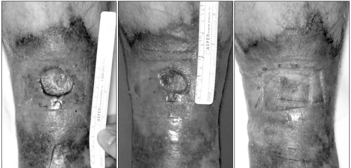 Fig. 4. Two years after compression therapy. There was no evidence of recurrence.