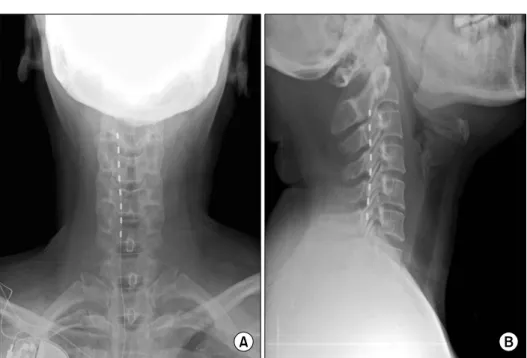 Fig.  1.  The  tip  of  the  electrode was  located  at  the  2nd  cervical vertebral  level  (A,  B).