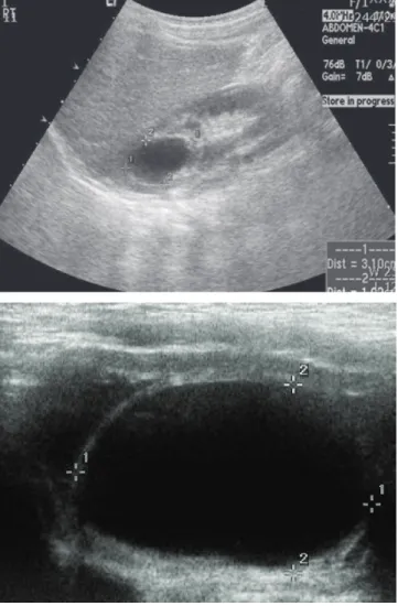 Fig. 3. Magnetic resonance imaging showed a markedly dilated upper pole  collecting system of right kidney in association with a large ureterocele