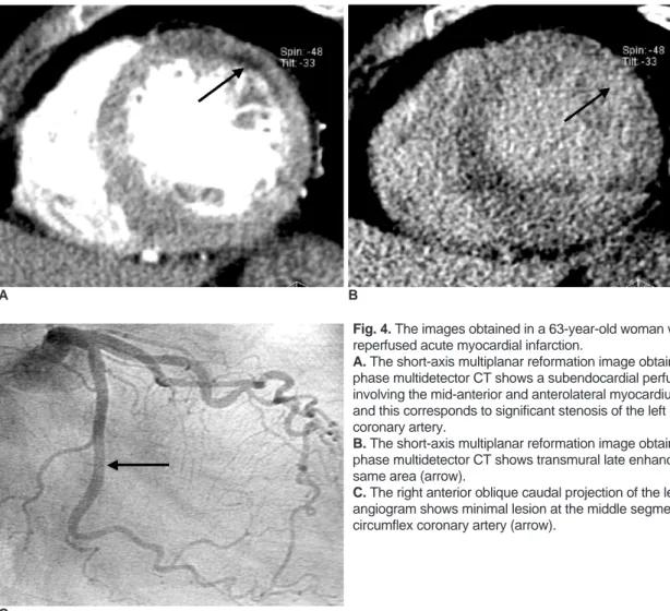 Fig. 4. The images obtained in a 63-year-old woman with reperfused acute myocardial infarction.