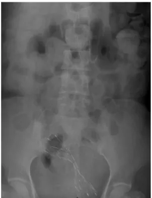Fig. 2. Stent fracture of the type 2 stent in a 64-year-old patient.