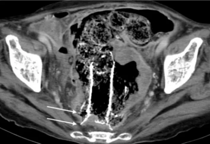 Fig. 4. Tumor ingrowth of the type 3 stent in a 65-year-old patient.