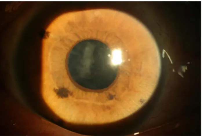 Fig.  1.  The  tube  is  inserted  through  the  ciliary  sulcus.