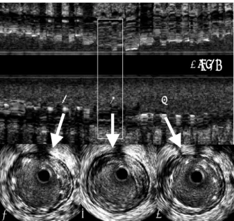Fig. 2 . Top: Longitudinal IVUS reconstruction of the RCA; the white vertical square corresponds to the point of stent fracture