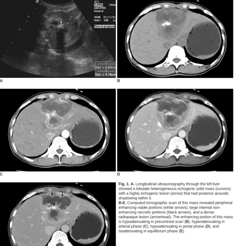 Fig. 1. A. Longitudinal ultrasonography through the left liver showed a lobulate heterogeneous echogenic solid mass (cursors) with a highly echogenic lesion (arrow) that had posterior acoustic shadowing within it.