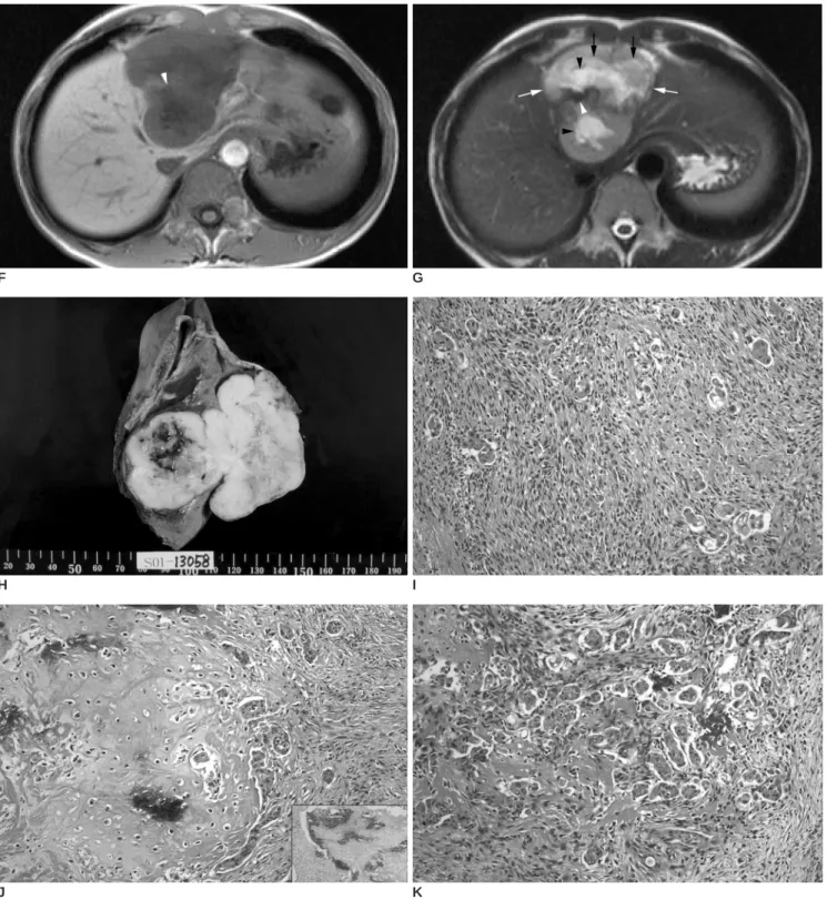 Fig. 1. F-G. Upon magnetic resonance imaging this mass is hypointense on the T1-weighted image (F) and hyperintense on the T2- T2-weighted image (G)