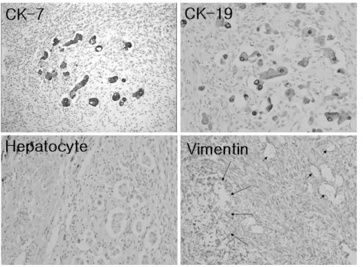 Fig. 1. L. The epithelial component was positive for cytokeratin 7 and 19  (cholan-giocytic differentiation markers), but negative for hepatocyte (hepatocytic differentiation marker)