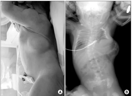 Fig.  3.  Frontal  view  of  chest  x-ray  reveals  multiple  segmentation  anomalies  of  the  cervical  and  thoracic  spine  such  as   butter-fly  vertebrae  and  hemivertebrae  resulting  in  severe   sco-liosis
