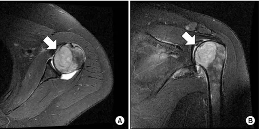 Fig. 1. Magnetic resonance  imaging. T2-weighted axial  image (A) and coronal image (B) shows osteolytic lesion  involving left humeral head  and metaphysis