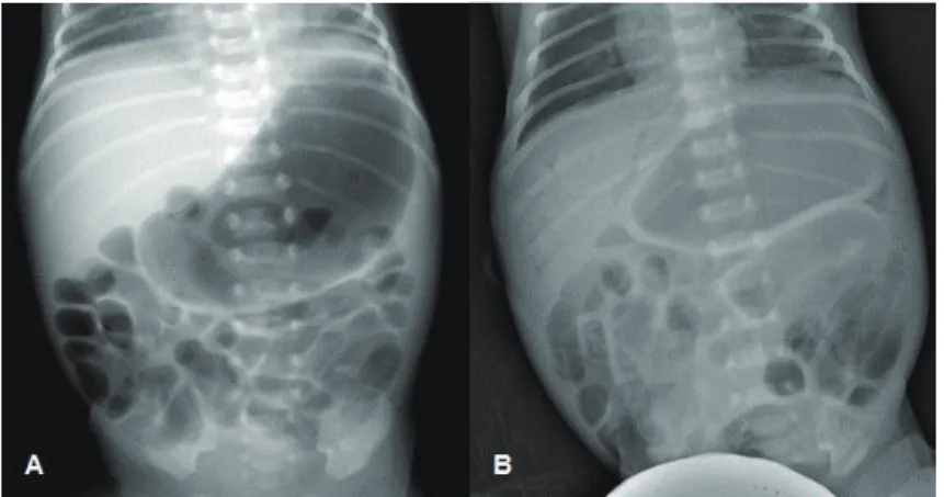 Fig. 1. The finding of plain abdominal x-rays of necrotizing enterocolitis. (A) Gaseous  distension of the stomach and bowel loops in case 1
