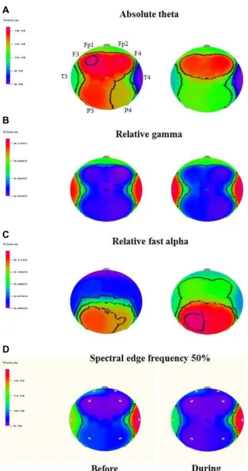 Fig. 1. t-Mapping of absolute theta (A), relative gamma (B), rela- rela-tive fast alpha (C) and spectral edge frequency 50% (D) before and during the inhalation of essential oil of Z