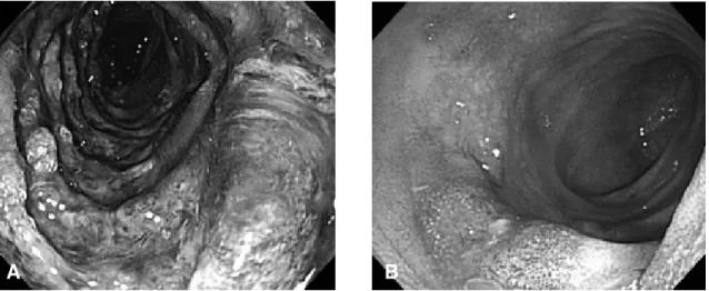 Figure  3.  (A)  Upper  GI  endoscopy  shows  diffuse  mucosal  necrosis  with  hemorrhage  at  the  descending  duodenum