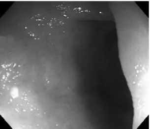 Figure  7.  Follow-up  colonoscopy.  Previous  colonic  lesions  such  as  ulcer  and  mucosal  bleeding  were  improved